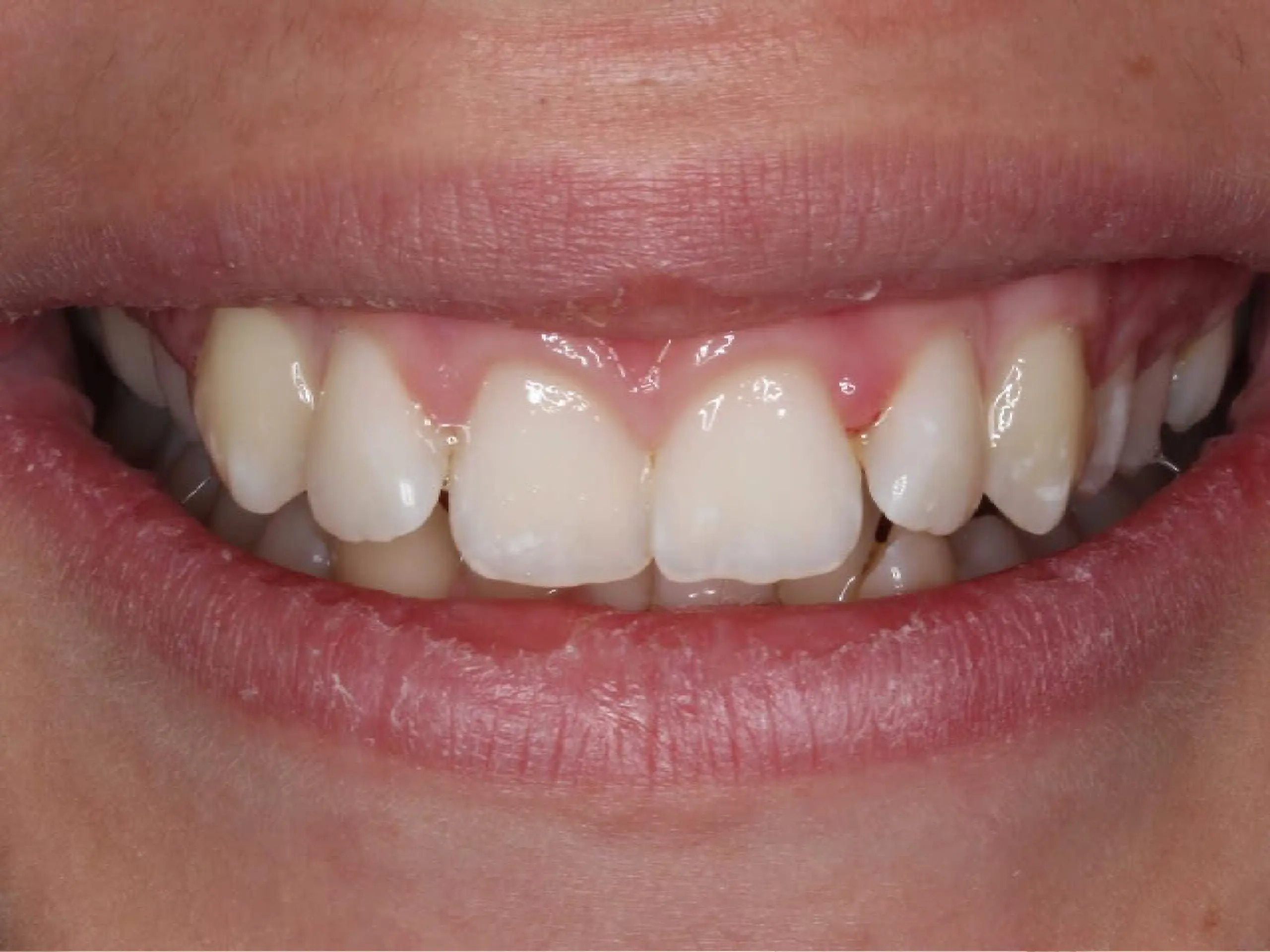 Primer plano de una sonrisa mostrando dientes frontales con un ligero apiñamiento y encías ligeramente inflamadas.