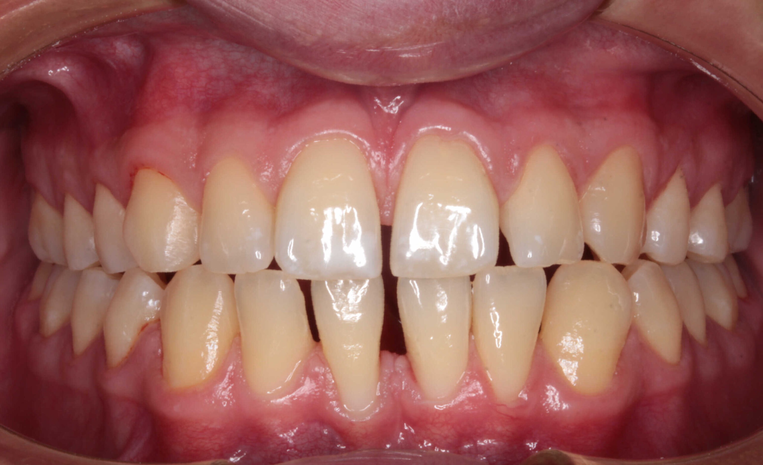 Primer plano intraoral de la dentadura de un paciente, mostrando la oclusión frontal con los dientes centrales inferiores apiñados, con la línea media ligeramente desviada.