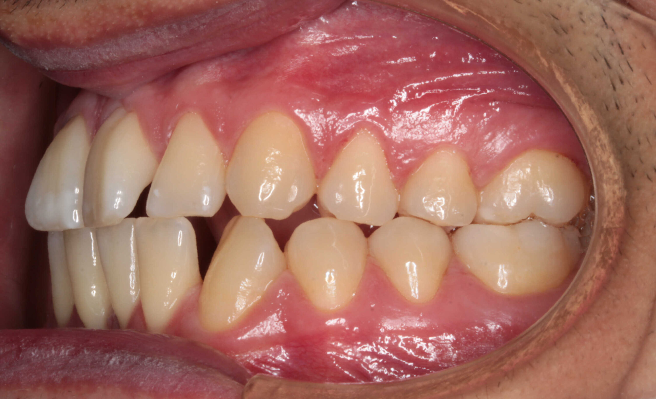 Primer plano intraoral de los dientes de un paciente, mostrando la oclusión lateral con piezas anteriores y posteriores alineadas y encías sanas.