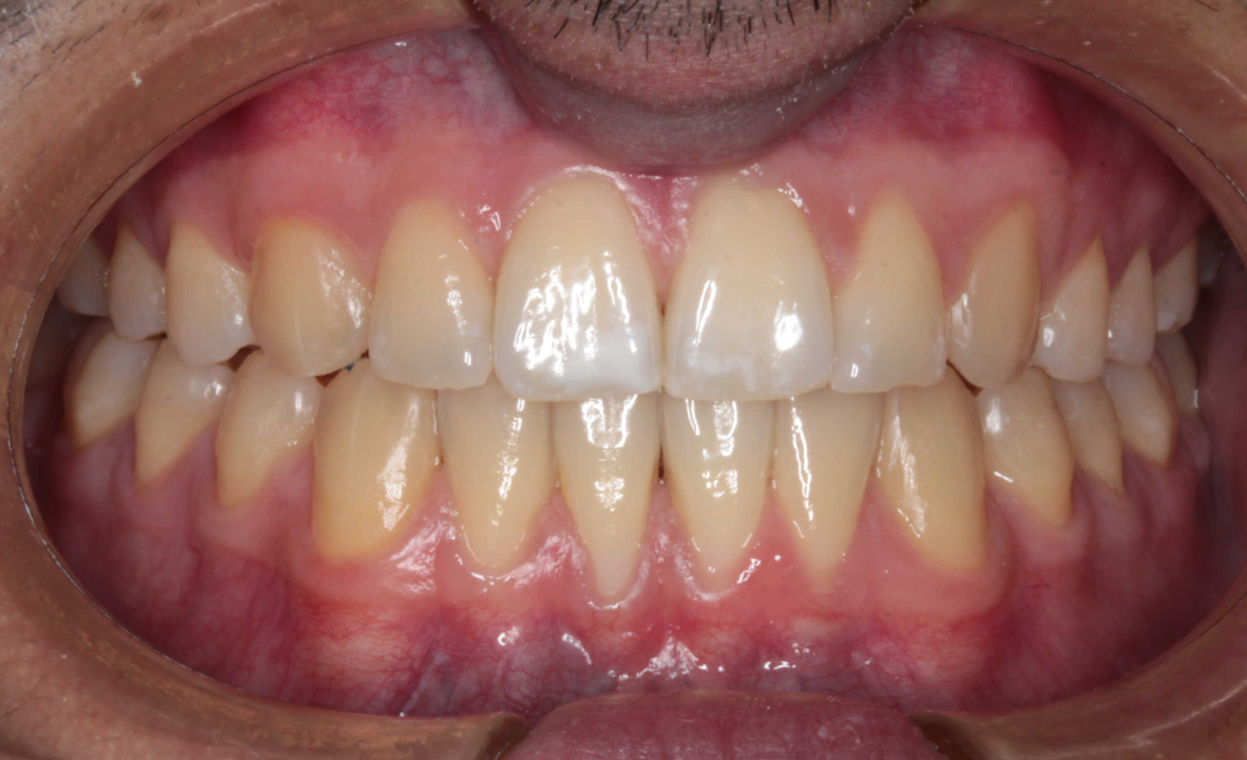 Primer plano intraoral de la dentadura de un paciente, mostrando la oclusión frontal completa con todas las piezas dentales bien alineadas y encías sanas.
