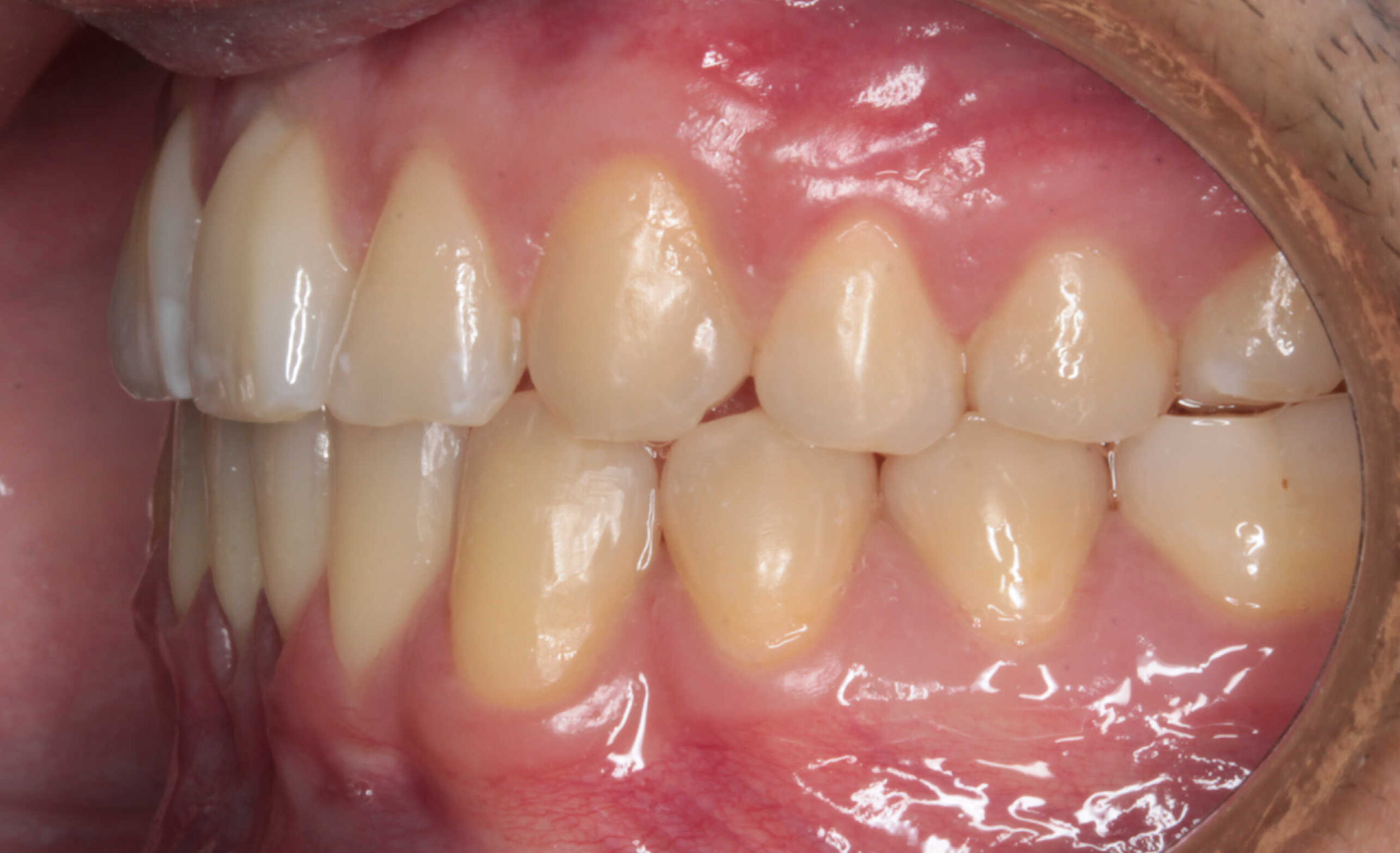 Primer plano intraoral de los dientes y encías de un paciente, mostrando la oclusión lateral izquierda con las piezas alineadas y las encías sanas.