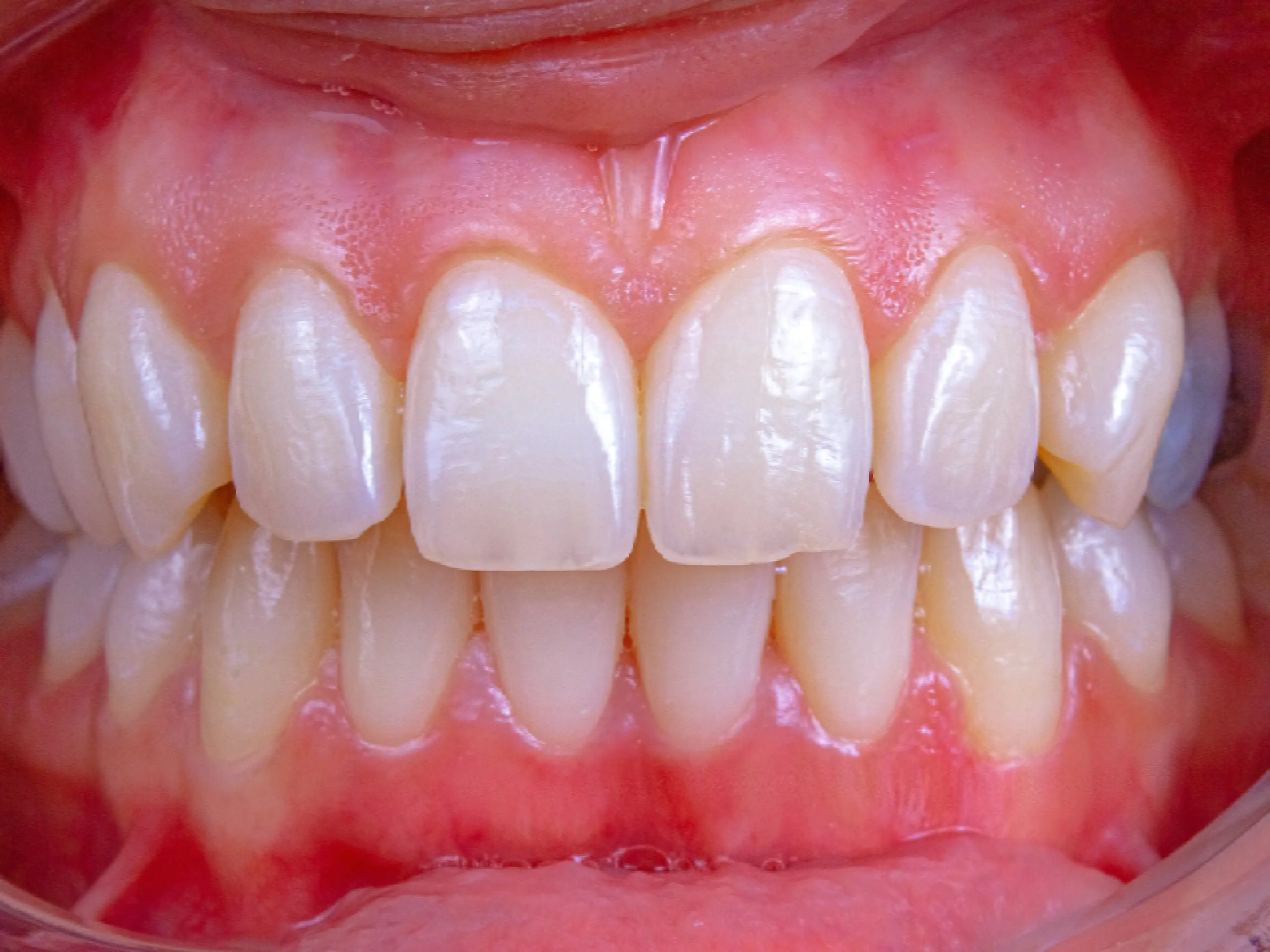 Primer plano intraoral de una dentadura con dientes naturales de color claro y encías rosadas.