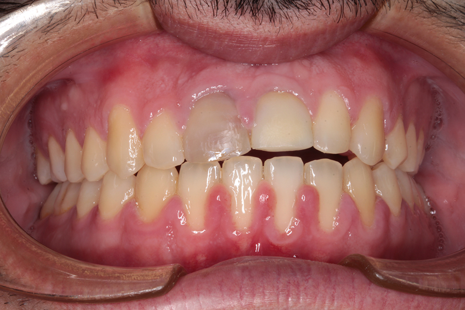Primer plano intraoral frontal de una dentición en oclusión con un incisivo central superior restaurado provisionalmente con una corona de acrílico opaca. Se observa gingivitis severa con enrojecimiento y recesión en el arco inferior.