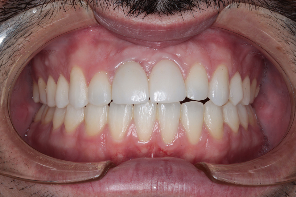 Primer plano intraoral frontal de una dentición en oclusión con restauraciones estéticas en los incisivos centrales superiores. Dientes bien alineados de color claro y encías ligeramente inflamadas.