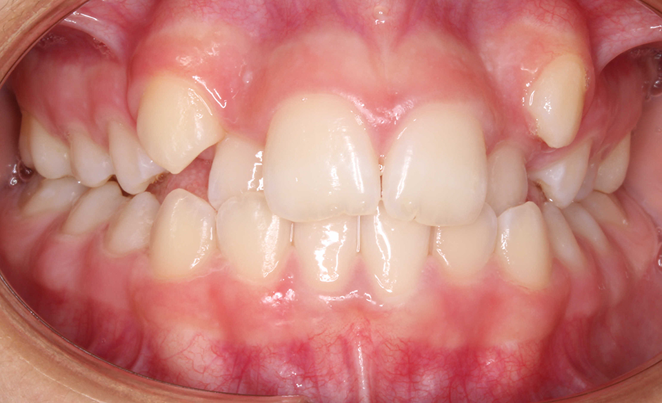 Primer plano intraoral frontal de una dentición en oclusión con maloclusión, apiñamiento superior severo, y caninos superiores retenidos o en erupción ectópica (fuera de lugar). Dientes de color claro y encías saludables.