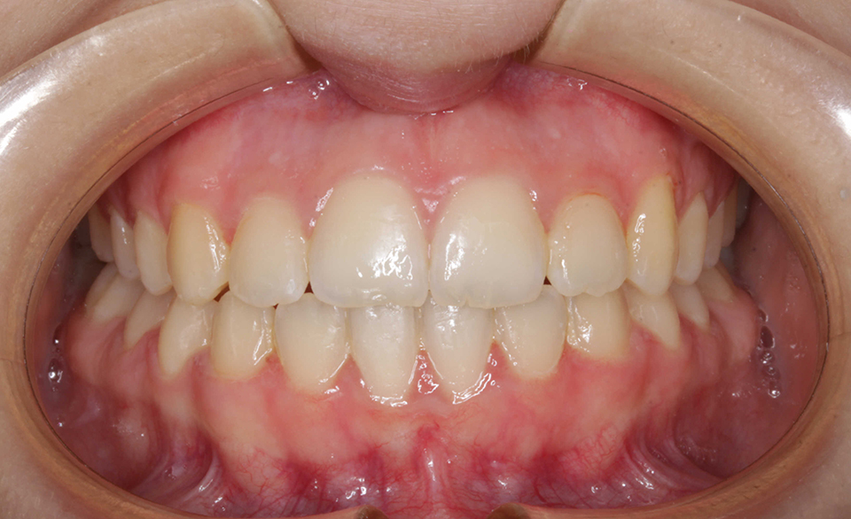 Primer plano intraoral frontal de una dentición en oclusión con dientes bien alineados de color blanco natural y encías rosadas, con una ligera prominencia en la línea media del paladar.