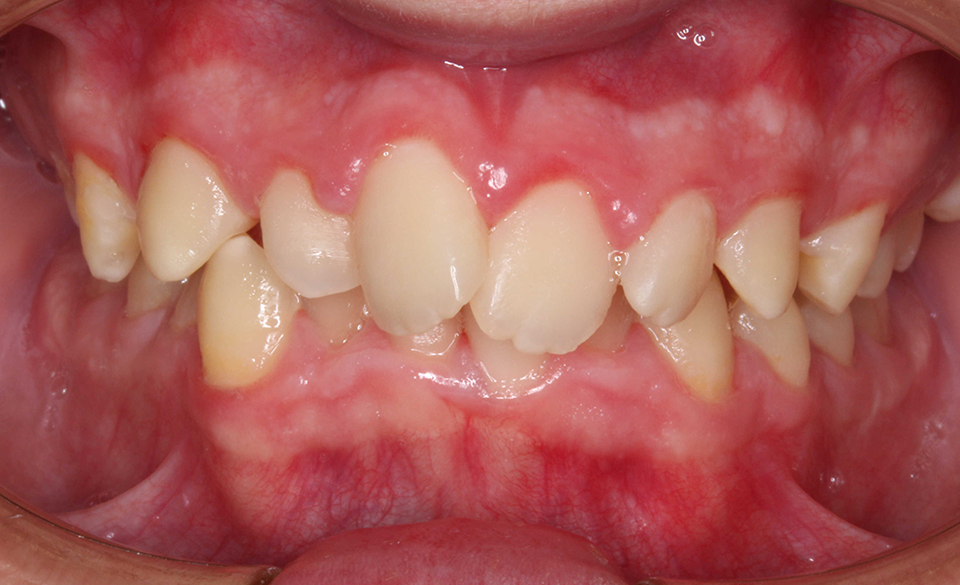 Primer plano intraoral frontal de una dentición en oclusión con maloclusión severa, apiñamiento y una mordida cruzada anterior. Dientes de color amarillento y encías inflamadas.