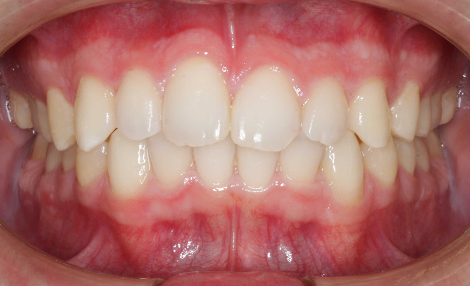Primer plano intraoral frontal de una dentición en oclusión con dientes bien alineados de color blanco natural y encías que muestran un leve enrojecimiento.