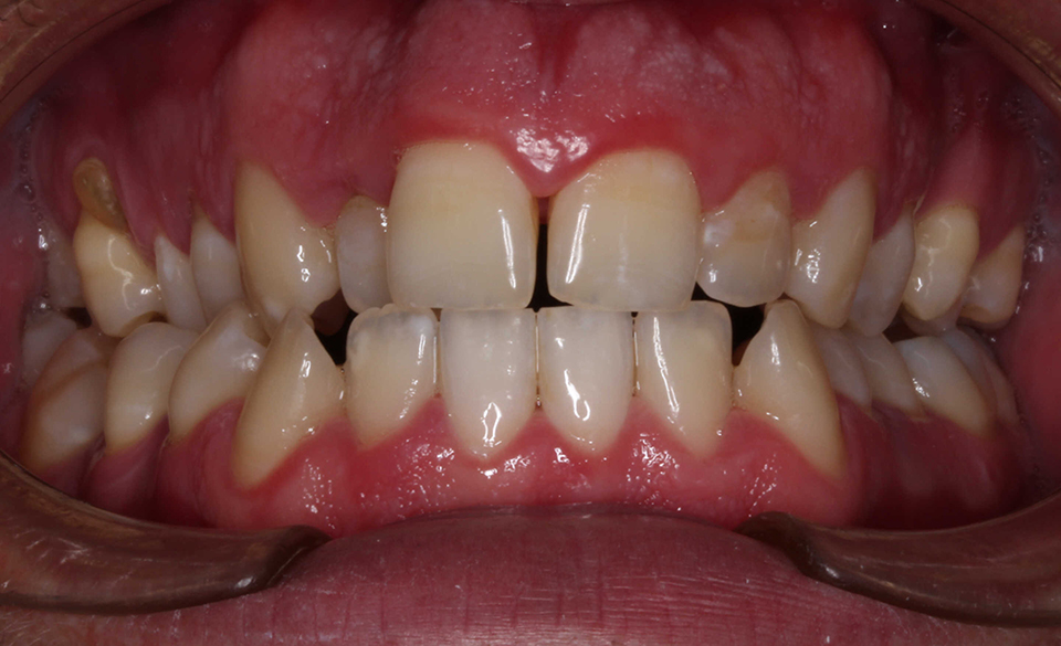 Primer plano intraoral frontal de una dentición en oclusión con dientes de color natural, apiñamiento dental y un diastema entre los incisivos centrales superiores. Se observa inflamación gingival generalizada.