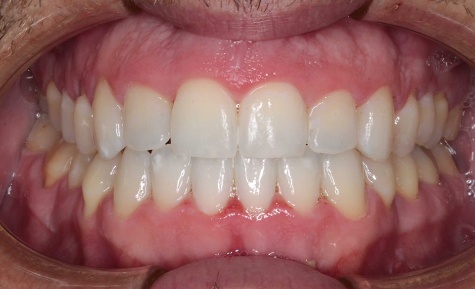 Primer plano intraoral frontal de una dentición en oclusión con dientes de color claro y encías rosadas. Se observan pequeñas restauraciones o carillas estéticas en los incisivos centrales superiores.
