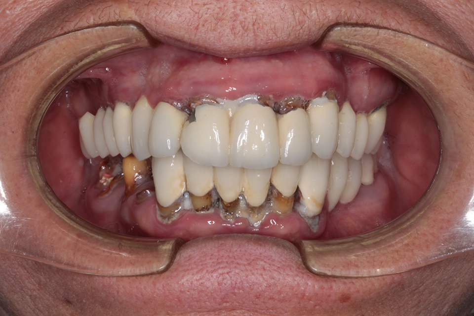 Primer plano intraoral frontal de una dentición con prótesis parcial fija en el arco superior y dentición natural inferior con caries severa y acumulación de placa/sarro.