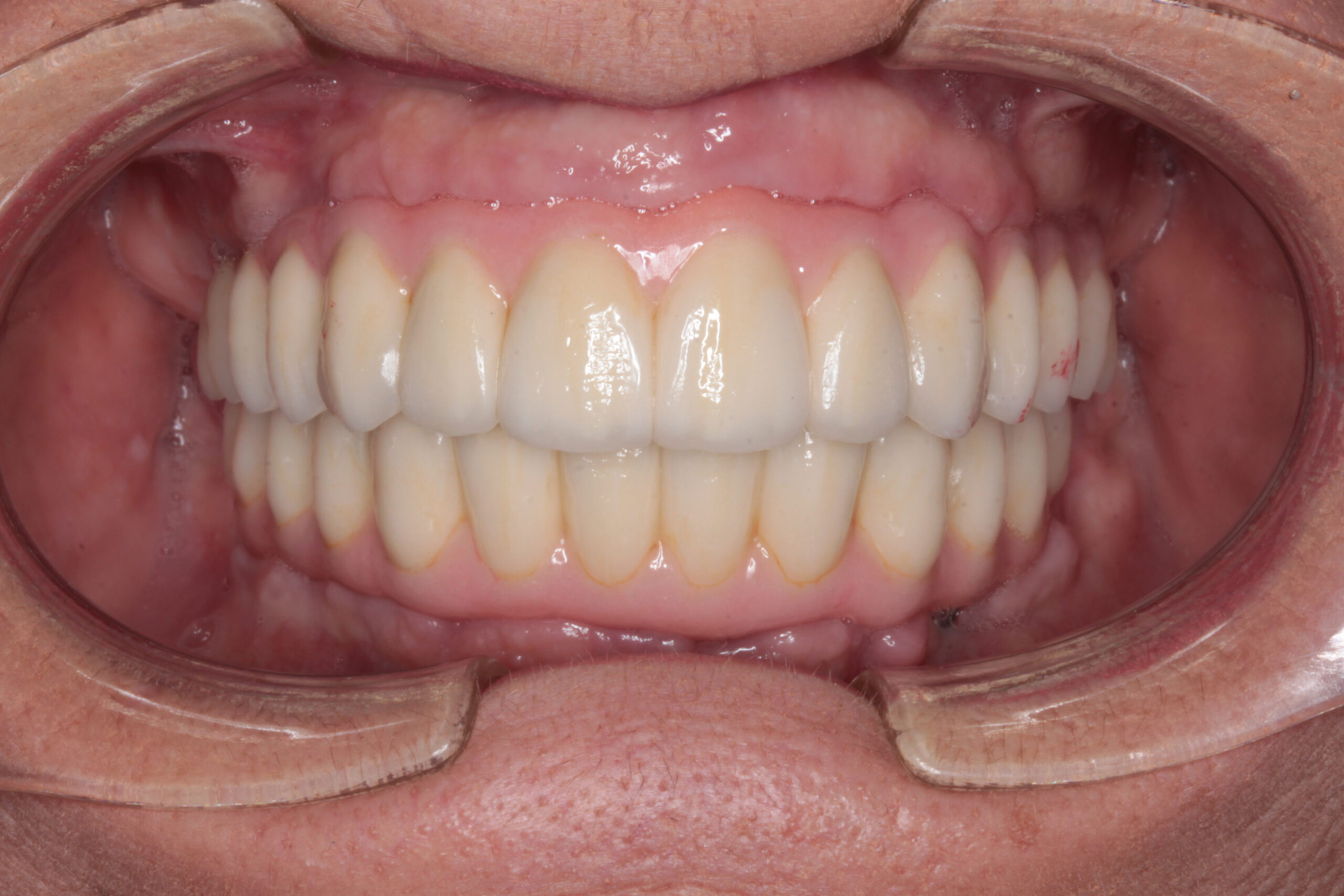 Primer plano intraoral frontal de una boca con prótesis dentales completas (dentaduras postizas) tanto en el arco superior como en el inferior, mostrando dientes de color claro y bases protésicas de color rosa imitando la encía.