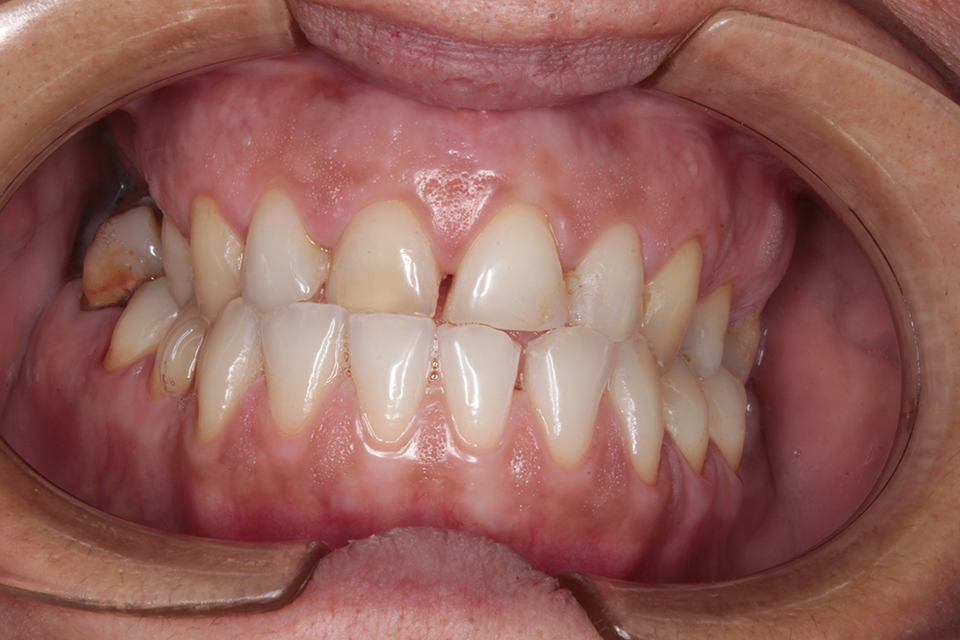 Primer plano intraoral frontal de una dentición en oclusión con dientes de color natural, un ligero diastema entre los incisivos centrales superiores y una restauración distal grande y oscurecida en el primer molar superior derecho.