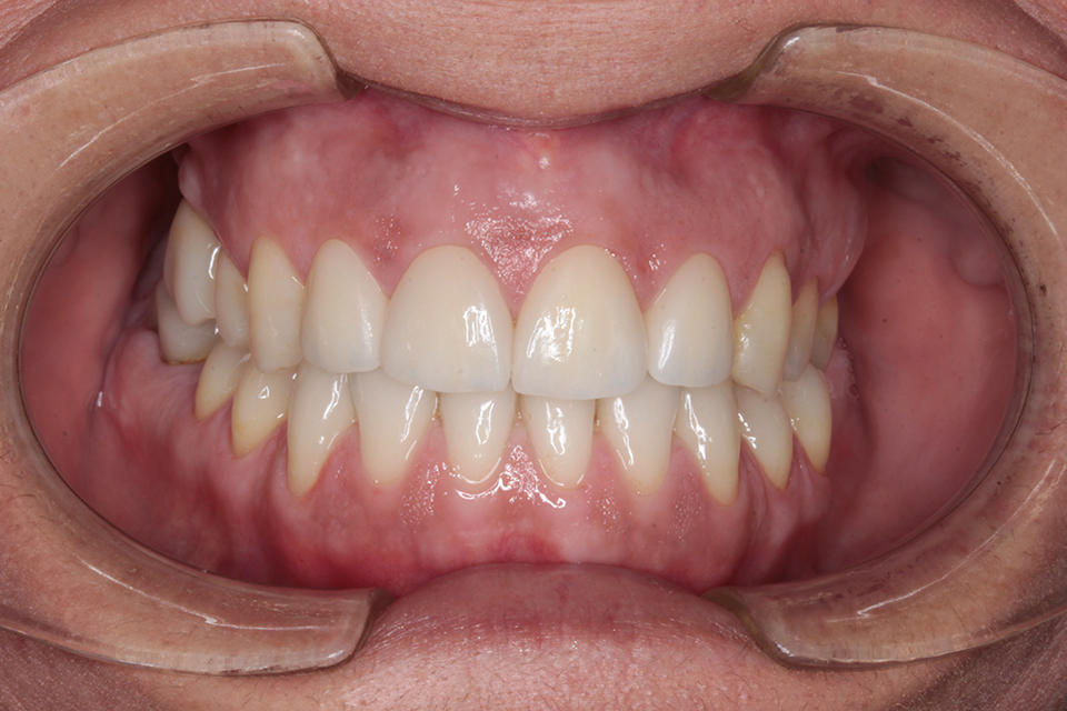 Primer plano intraoral frontal de una dentición en oclusión con dientes restaurados en el sector anterior superior y dientes naturales en el sector inferior.