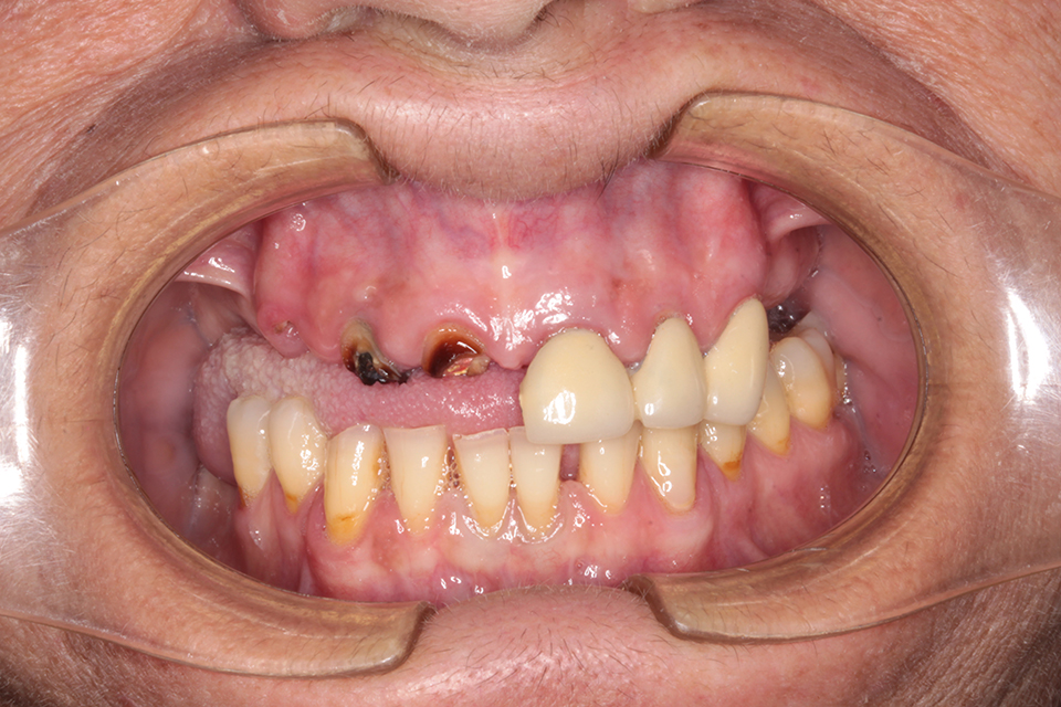 Primer plano intraoral frontal de una boca con dentición muy comprometida. El arco superior muestra ausencia de múltiples dientes, un resto radicular cariado y una prótesis parcial fija o provisional. El arco inferior muestra dentición natural con tinción y desgaste.