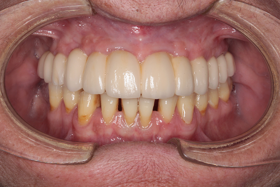 Primer plano intraoral frontal de una dentición con una prótesis fija completa o parcial en el arco superior, mostrando dientes superiores de color claro y dientes inferiores con tinción y retracción gingival.