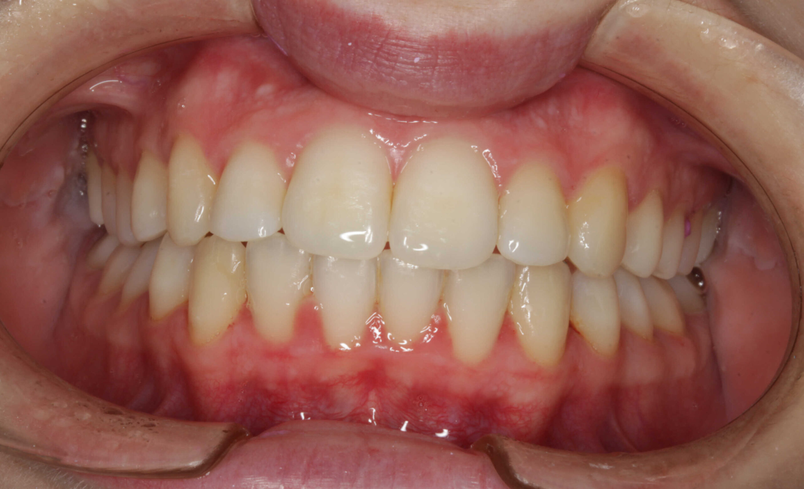 Vista intraoral frontal de los dientes superiores e inferiores en oclusión céntrica, mostrando una alineación adecuada y dientes de color natural.