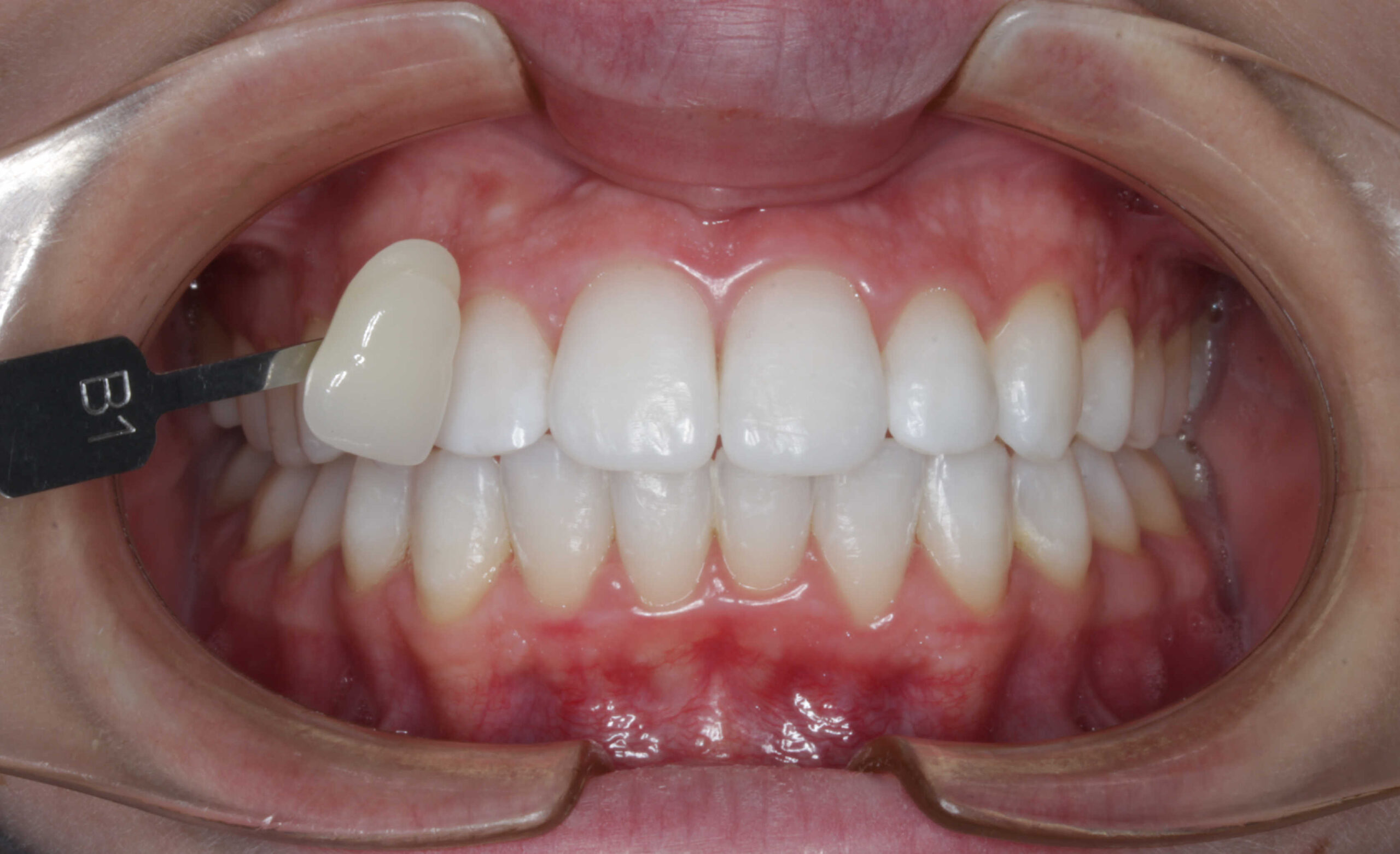 Vista intraoral frontal de los dientes superiores e inferiores con un guía de color dental (tonalidad B1) colocado junto al incisivo lateral superior para comparar el color. Los dientes son blancos y brillantes, indicando blanqueamiento o restauraciones.
