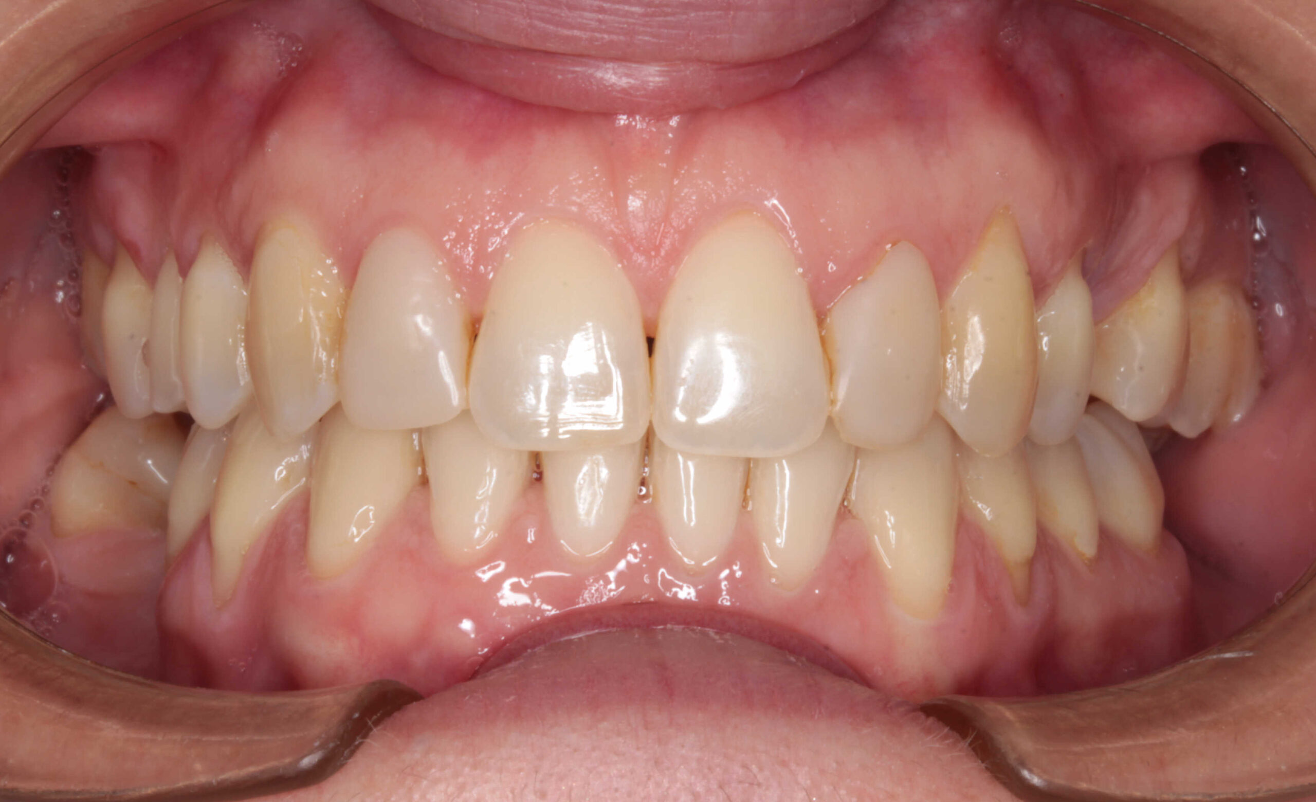 Vista frontal intraoral de la oclusión de un paciente, mostrando los arcos dentales superior e inferior, con los labios retraídos por un separador.
