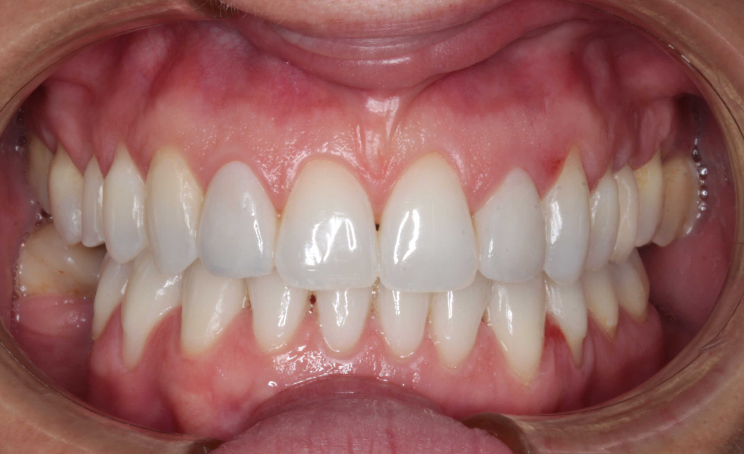 Primer plano intraoral de dentadura superior e inferior con sonrisa natural y encías saludables