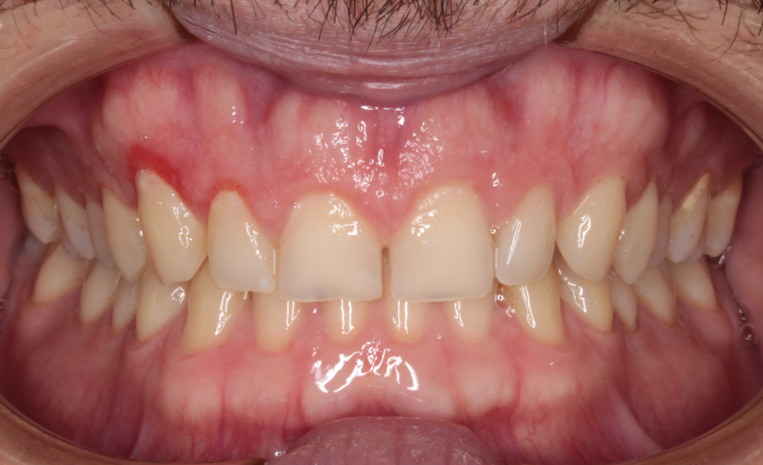 Vista intraoral frontal de los dientes superiores e inferiores en oclusión que muestra inflamación y enrojecimiento severo de la encía (gingivitis) alrededor del canino superior izquierdo.