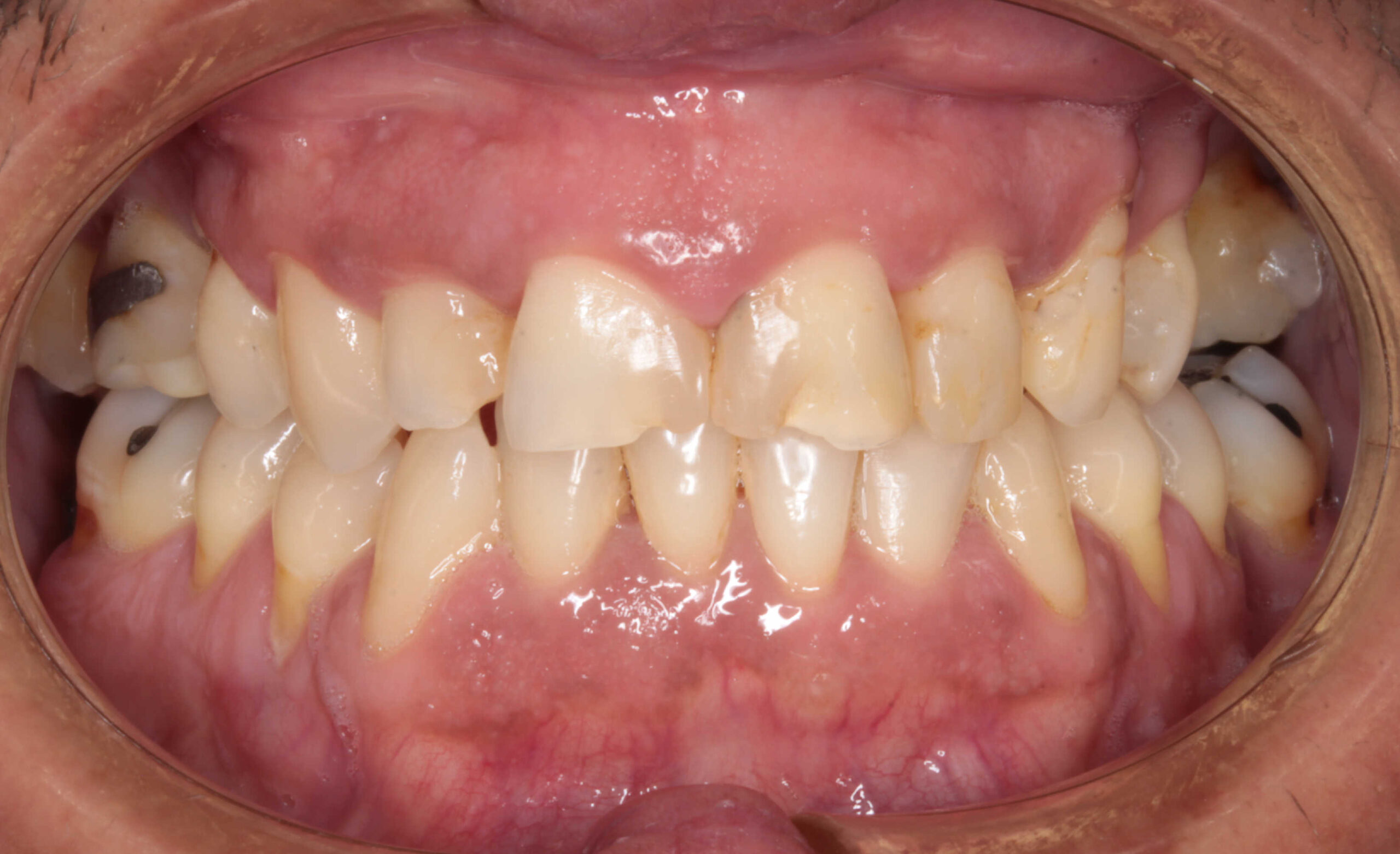 Vista intraoral frontal de los dientes superiores e inferiores en oclusión. Muestra recesión gingival, restauraciones de amalgama posteriores y ligeros signos de desgaste.