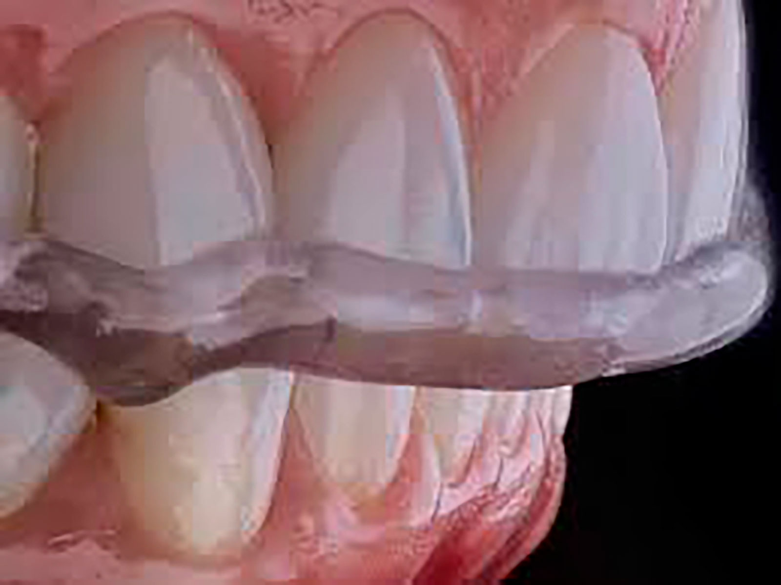 Primer plano de una férula de descarga (placa oclusal) colocada sobre un modelo de dientes superiores.