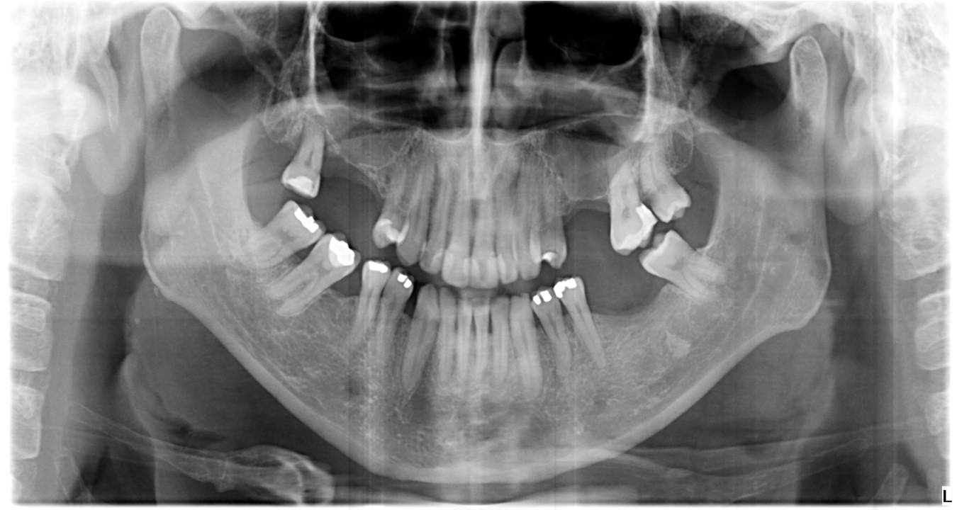 Radiografía panorámica dental con pérdida ósea severa, múltiples dientes ausentes, y remanentes radiculares o coronas clínicas sin soporte.