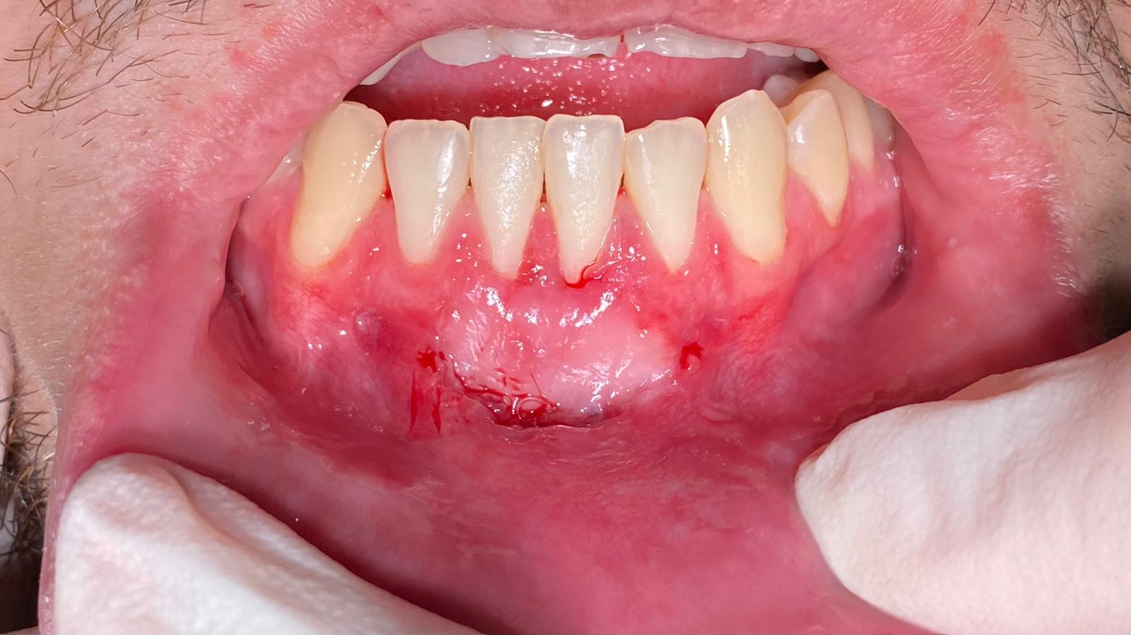 Fotografía clínica de boca abierta mostrando encías inflamadas y heridas recientes en el maxilar inferior.
