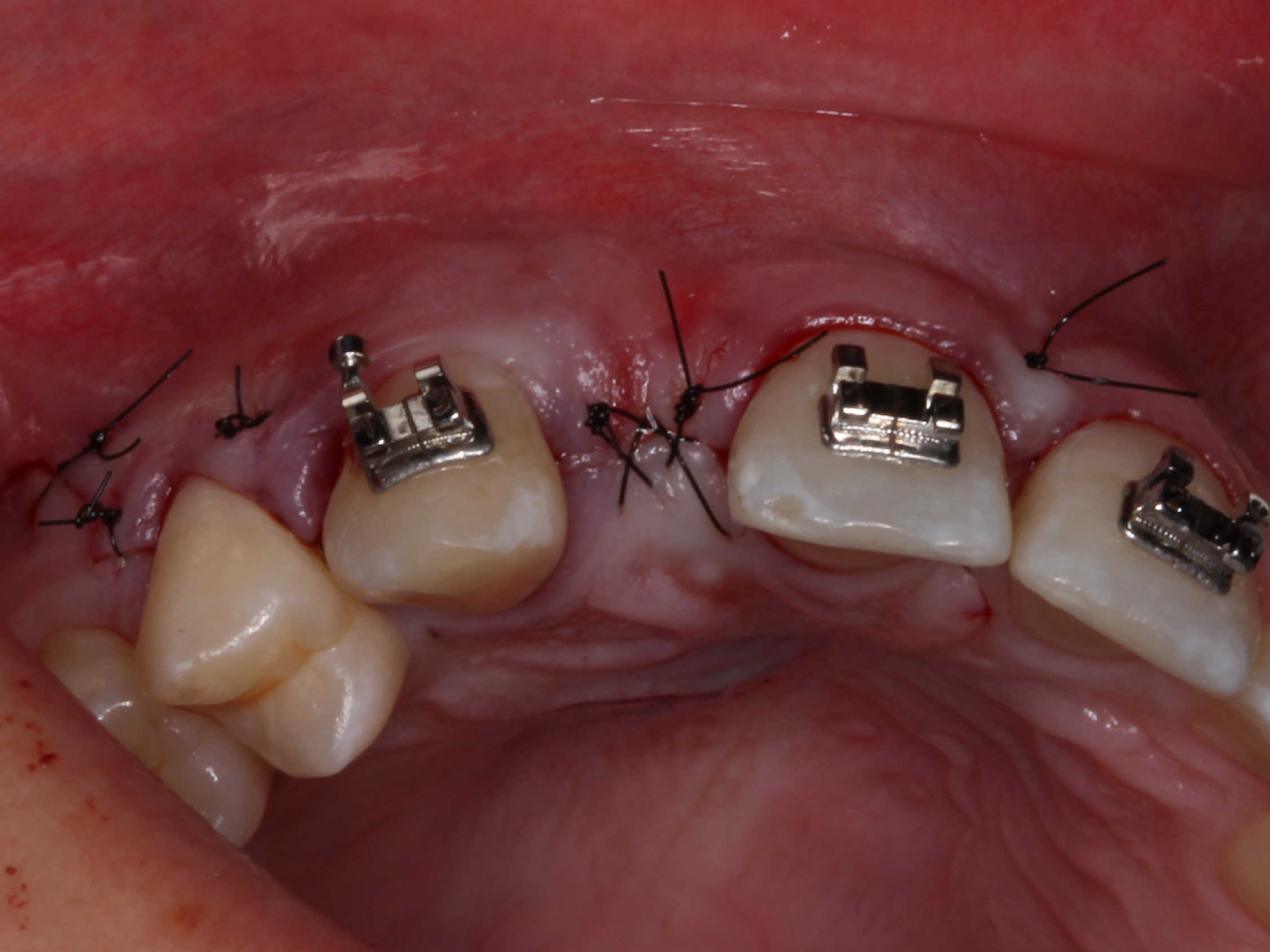 Vista intraoral del paladar con brackets ortodónticos en premolares y puntos de sutura negros después de un procedimiento quirúrgico gingival.