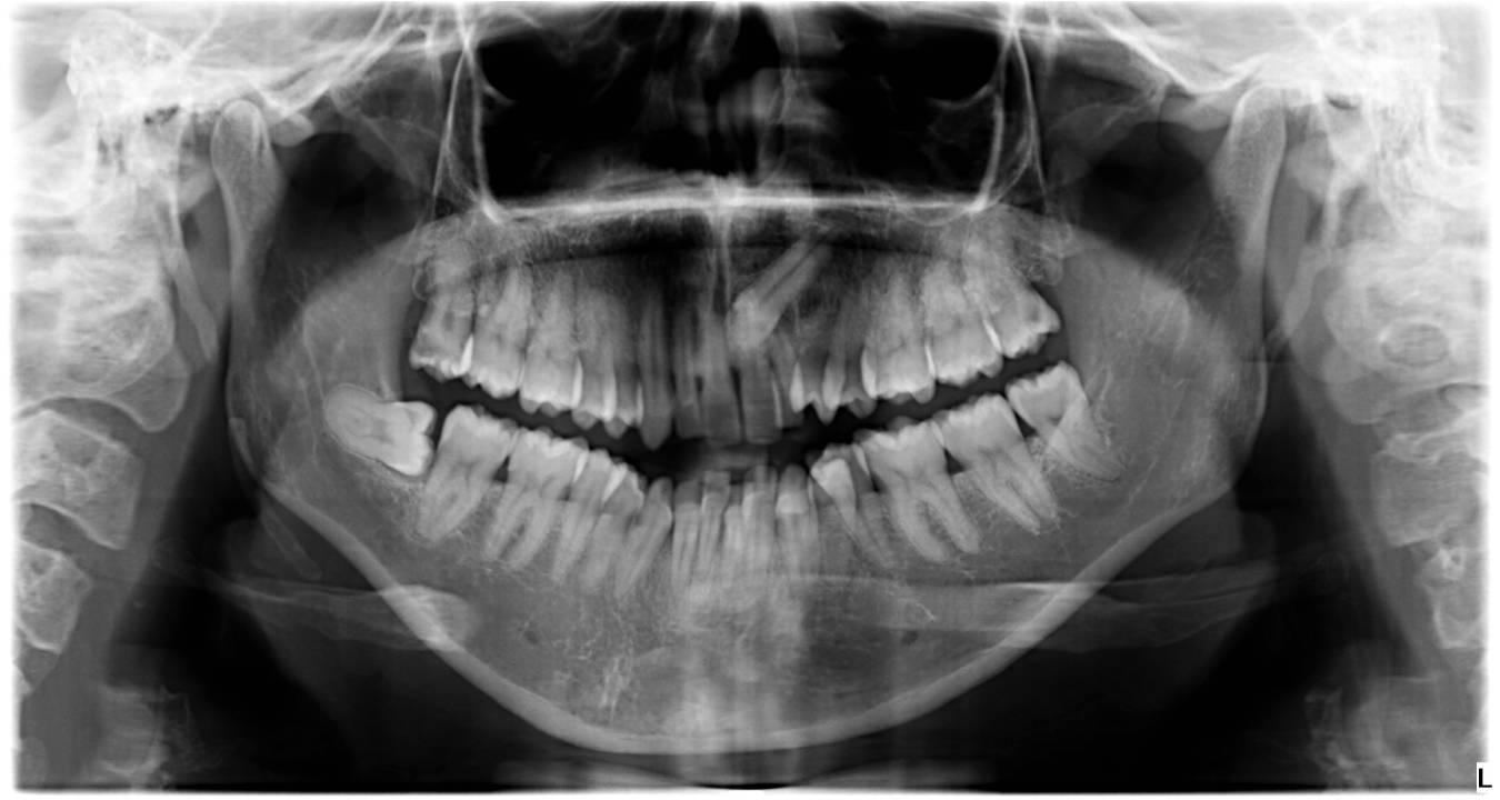 Radiografía panorámica dental que muestra dentición natural completa, incluyendo muelas del juicio impactadas.