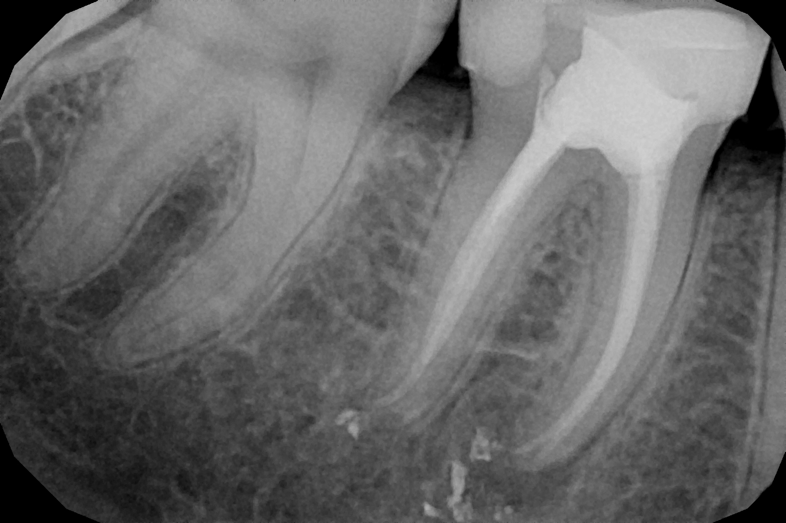 Radiografía periapical de un molar con tratamiento de conducto y premolares adyacentes, mostrando la estructura radicular y ósea.